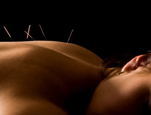 Acupuncture